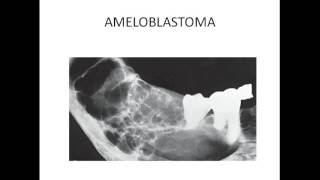 Maxillofacial radiology  MULTILOCULAR RADIOLUCENCY OF JAW [upl. by Samp964]