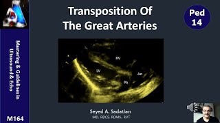 Transposition of the great arteries TGA [upl. by Lira305]