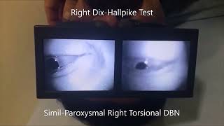 Apogeotropic Left Posterior Semicircular Canal BPPV [upl. by Bolitho]