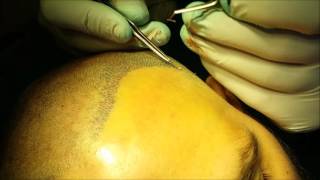 FUE Hair Transplant  Wimpole Clinic [upl. by Nathanael]