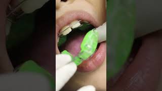 La ortopedia funcional 😲🦷 smile ortodoncia brackets ortopedia [upl. by Areikahs]