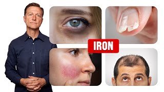 How Iron Affects Your Hair Skin and Nails [upl. by Ennail860]