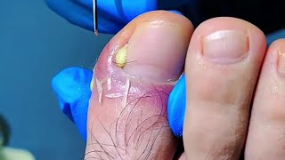 Patient Almost Cries When Deep Ingrown Toenail and Shocking Leg Hair Get Removed [upl. by Attezi303]