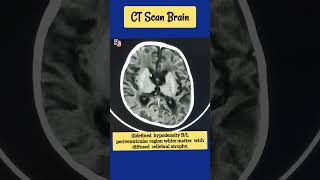 ill defined hypodensity BL periventricular region ctscan cva radiology [upl. by Bergerac63]