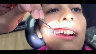 Deep bite Treatment options and challenges orthodontist drkapilsaroha orthodonticeducation [upl. by Etteniuq554]