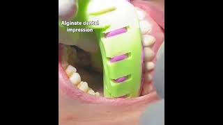 Alginate dental impression [upl. by Tam]