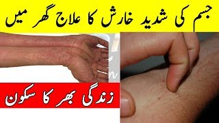 Itching In Body  Full Body Itching Treatment At Home  Kharish Ka Ilaj [upl. by Vanny]