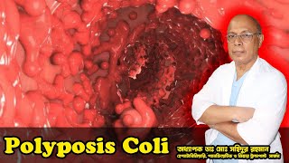 Polyposis Coli । কোলনে অসংখ্য পলিপ । অধ্যাপক ডাঃ মোঃ সহিদুর রহমান।LGSH [upl. by Jammal808]