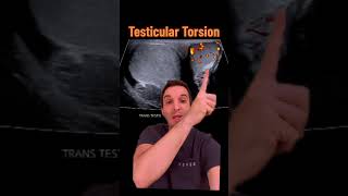 Diagnosing testicular torsion on ultrasound [upl. by Ahearn315]