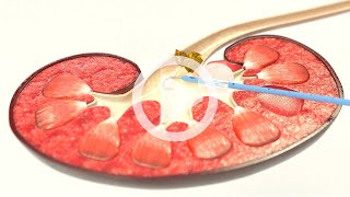 UROMED BallonKatheterSet NEPHROquick®  Anlage perkutaner NephrostomieKatheter zur Nierendrainage [upl. by Yenalem]