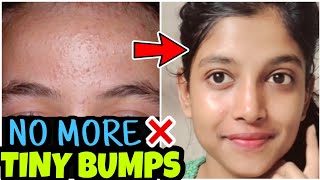 7 Days Challenge 😍Treat TINY BUMPS NATURALLY at home [upl. by Aloel]