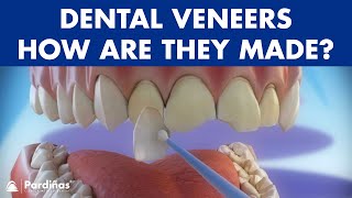 Veneers  How are they made Preparation and placement of cosmetic dentistry veneers © [upl. by Aceber815]