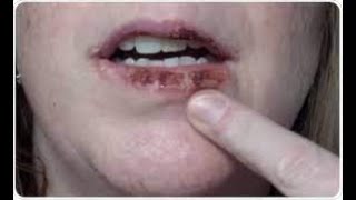 Actinic Cheilitis Symptoms and Causes  Diagnosis  Treatment  Prevention [upl. by Datha391]