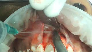 part 2 inverted and impacted  internal resobed mesiodens surgical removal [upl. by Eirrej]