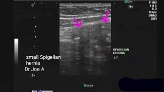 Spigelian hernia ultrasound video [upl. by Nalo]