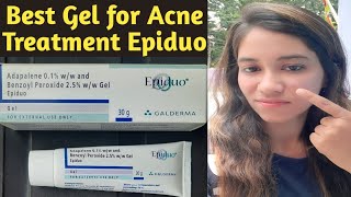 Epiduo Gel for acne amp acne scars  Gel to get rid of pimples  Best cream for acne treatment at home [upl. by Neyugn814]