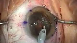 Modern Cataract Surgery Alcon ReSTOR IOL with LRI [upl. by Anthony]