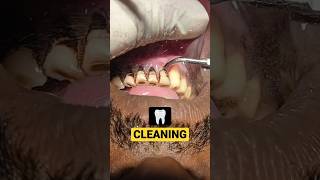 Pan  Smokers Teeth Cleaning teethcleaning dirtyteeth [upl. by Naimerej]