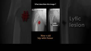 New v old Hip with Femur 12 Musculoskeletal Xray Viewing principles radiologychannel007 [upl. by Jehiel]