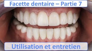 Facettes dentaires  Clinique Esthétique Aquitaine [upl. by Nally]