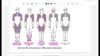 Myopathies part 3  Inherited myopathies  Harrison made easy [upl. by Egiaf]