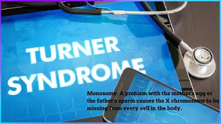 🔴Turner Syndrome🔴Turner syndrome is a rare genetic disorder seen only in girls👩 [upl. by Eoj]