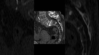 L5S1 grade 2 spondylolisthesis with microfractures degenerative changes in the pars interarticulari [upl. by Asli]