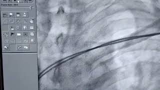 Radiographic Appearance of Pacemaker Dual Chamber explained by Prof Dr Vivek Gupta 2023 [upl. by Hotze52]