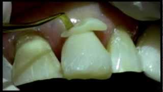 Anterior Restoration  Closing a subgingival margin [upl. by Aseuqram102]