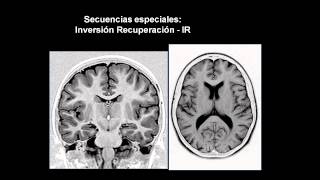 introducción a las neuroimágenes [upl. by Niltac306]