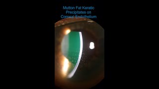 Intermediate Uveitis  Vitritis amp Mutton Fat KPs [upl. by Zohara]