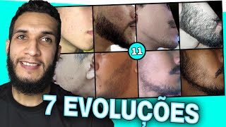 7 EVOLUÇÕES COM MINOXIDIL 11 [upl. by Kai]