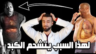 علاج سموم الكبد الدهني  شرح رائع لعلاج تشحم الكبد واعراضه بدون ادويه [upl. by Benis]