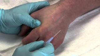 Intravenous Catheter Placement [upl. by Bamby]