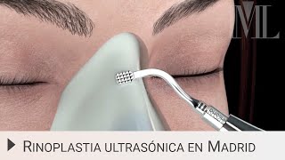 Transformación con Rinoplastia El Impactante Cambio de Cielo😮 [upl. by Ajad]