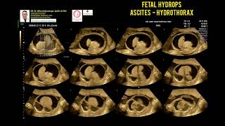 Fetal Hydrops Ascites Hydrothorax [upl. by Sunil]