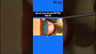 Spinal Anesthesia  Epidural Anesthesia  How Spinal Anesthesia is given shortsviral [upl. by Frangos]