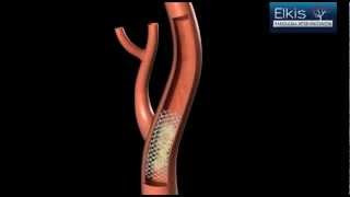 Angioplastia de artéria carótida protegida com Stent  Técnica cirúrgica Endovascular [upl. by Nnaylime390]