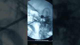 Trigeminal Neuralgia  Most advanced Treatment Percutaneous Balloon Compression [upl. by Corliss376]