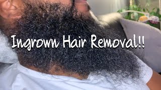 The Most Satisfying Ingrown Hair Removal From Beard [upl. by Camm]