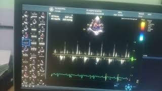 Global hypokinesia of lv severe lv severe TR moderate MR [upl. by Sidonia631]