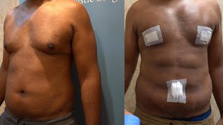 Gynecomastia Surgery 48 hrs Post Op on Wisconsin MALE [upl. by Nairehs722]