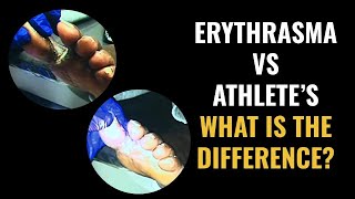 Erythrasma vs Athletes Foot  What is the difference [upl. by Cerallua]