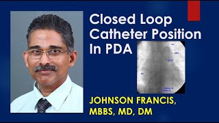 Closed Loop Catheter Position In Patent Ductus Arteriosus PDA [upl. by Appledorf]