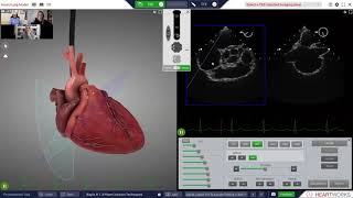 TEE Transeptal Online Training [upl. by Stacey]