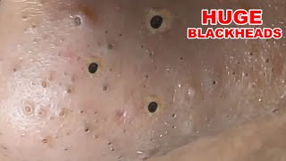 Blackheads Extraction On The Nose part 1 [upl. by Ramo]