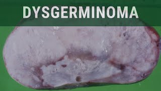 Ovarian Dysgerminoma  Pathology mini tutorial [upl. by Ahtiuqal]