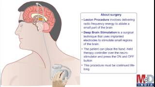 Surgical Treatment For Parkinsons Disease [upl. by Herrick]