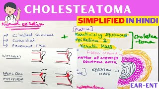 Cholesteatoma  Hindi  ENT [upl. by Pomfret318]