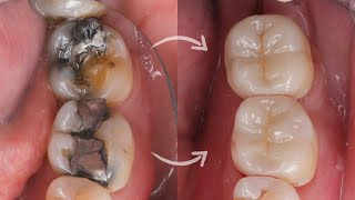 Ceramic ONLAY amp OVERLAY cementation StepbyStep [upl. by Nytsua]